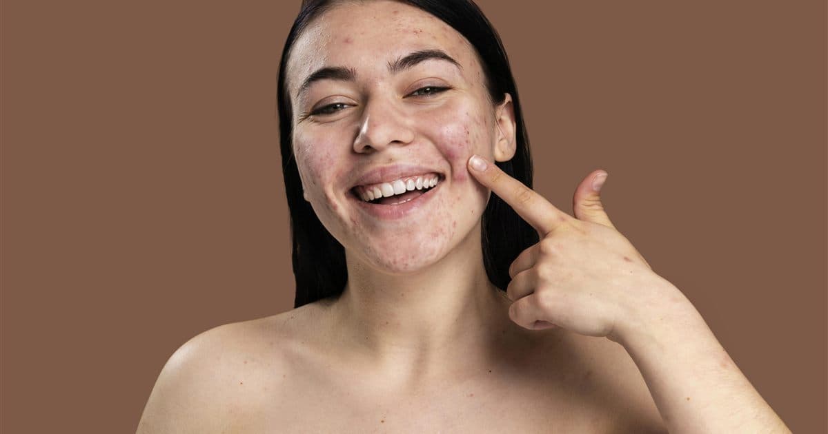 Mulher mostrando a acne no rosto antes de iniciar o tratamento com isotretinoína