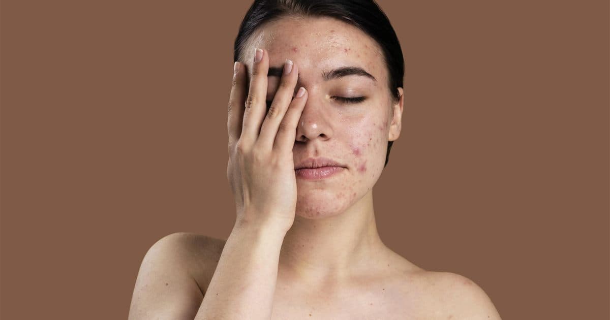 Tratamento de acne online: é possível receber receita de isotretinoína (Roacutan)?