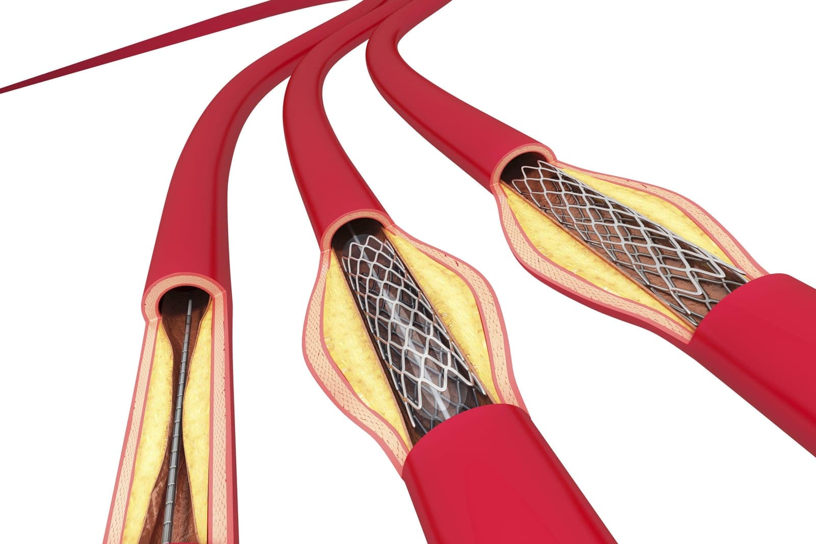 Ilustração de stent sendo implantado em artéria coronária com placas de gordura durante o cateterismo cardíaco
