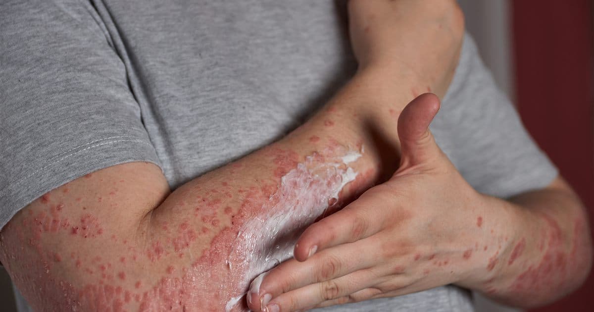 Aplicação de hidratante na pele com dermatite atópica, parte essencial da rotina de cuidado