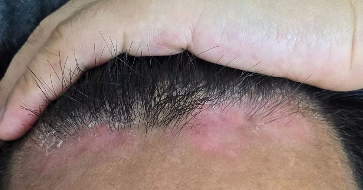 Dermatite seborreica: sintomas, causas e tratamento