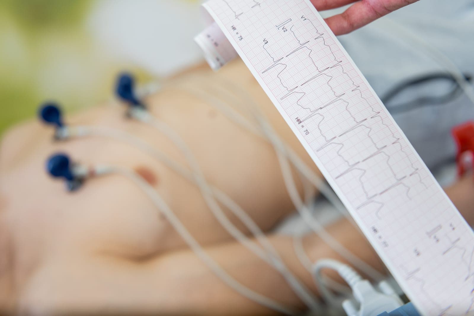 Profissional segurando o traçado impresso do eletrocardiograma ao lado do paciente conectado aos eletrodos