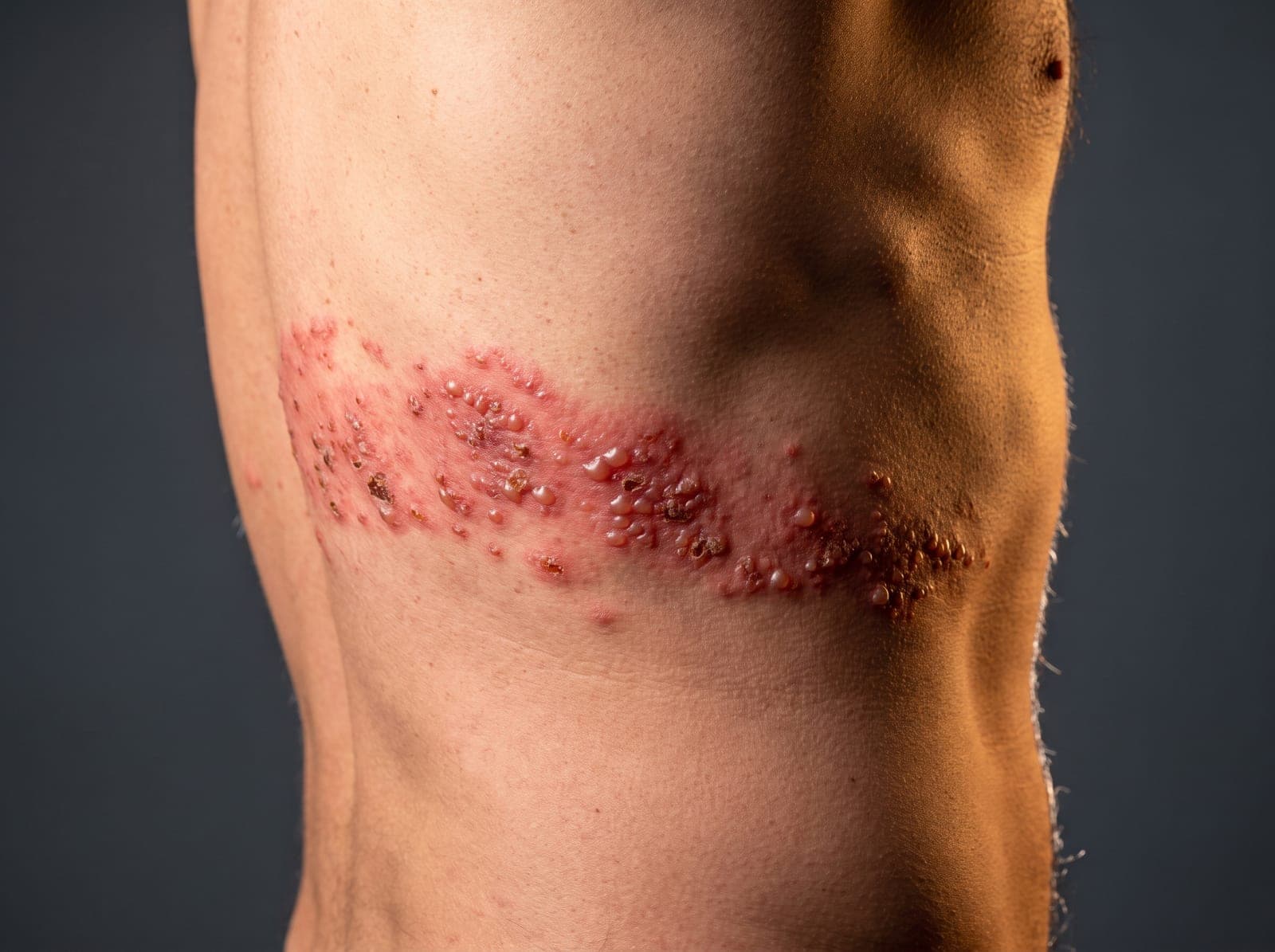 Herpes Zóster (Cobreiro): O Que É, Sintomas e Como Tratar Online