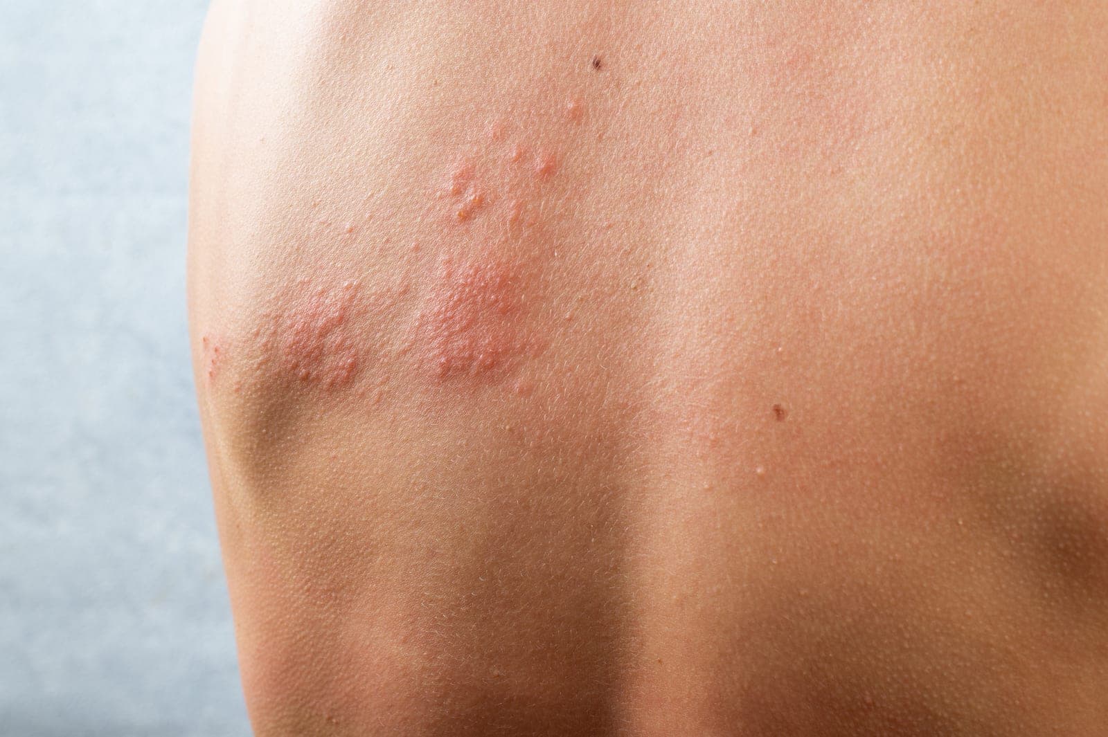 Lesões avermelhadas agrupadas em um lado das costas, na fase inicial do herpes zóster, antes da formação das bolhas