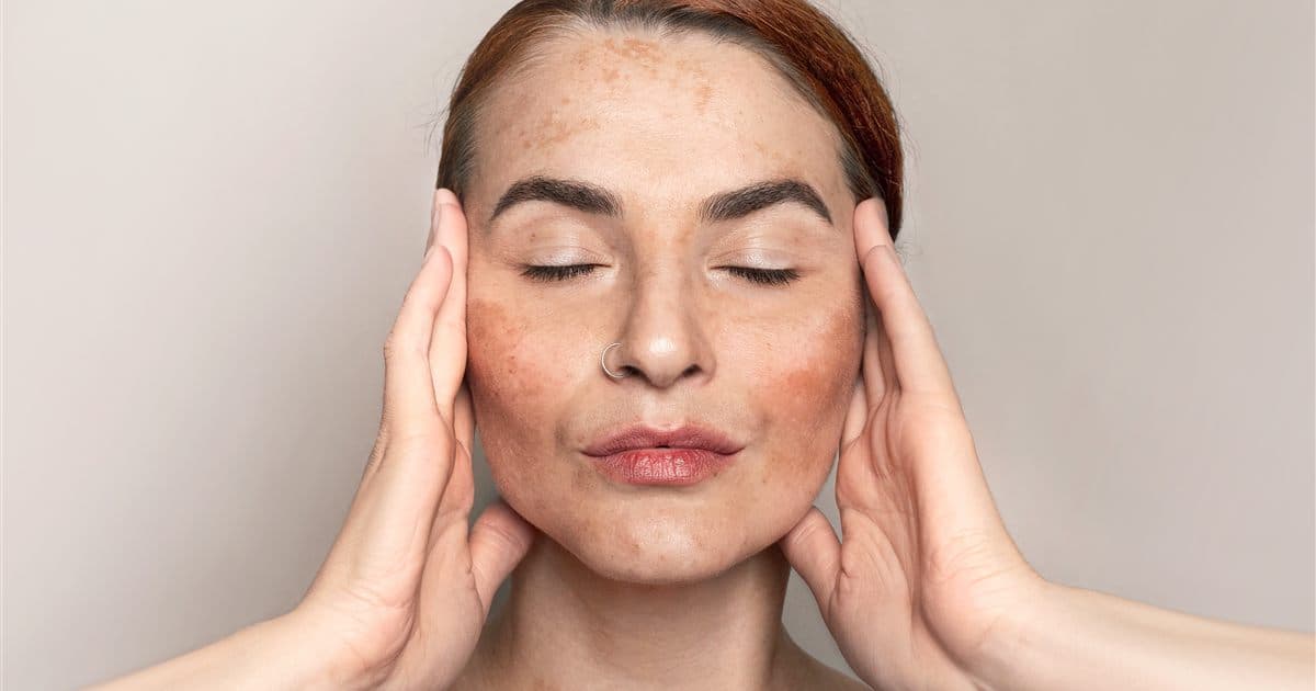 Melasma: causas, tratamento e como prevenir as manchas no rosto