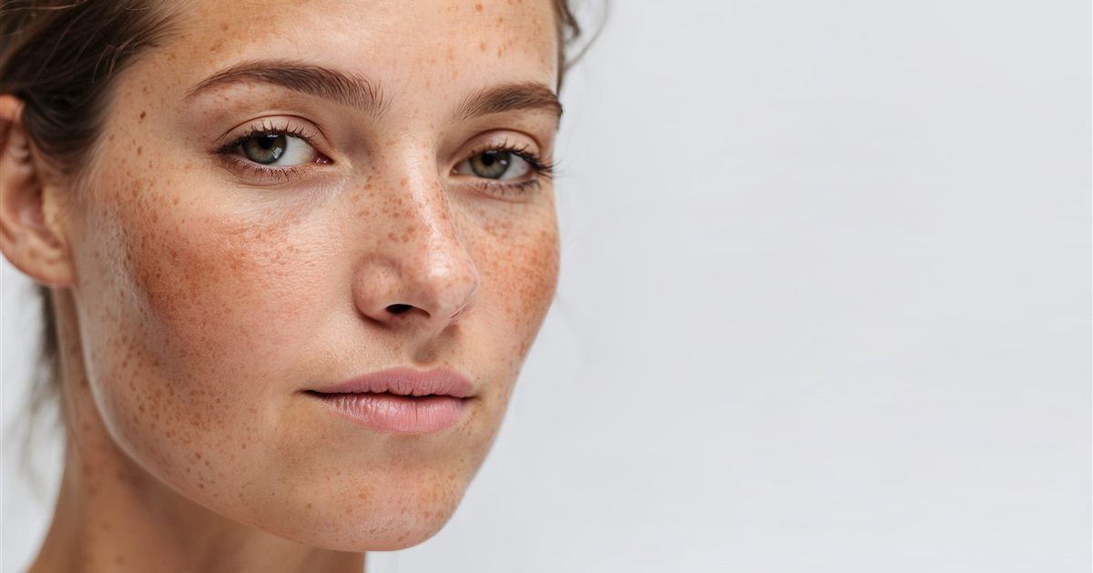 Close de rosto com manchas de melasma antes do tratamento dermatológico